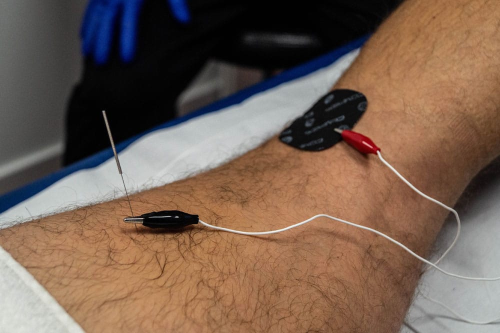 clinica de fisioterapia en vigo con Neuromodulación para tratamientos ecoguiados técnicas mínimamente invasivas para acelerar la recuperación de lesiones complejas