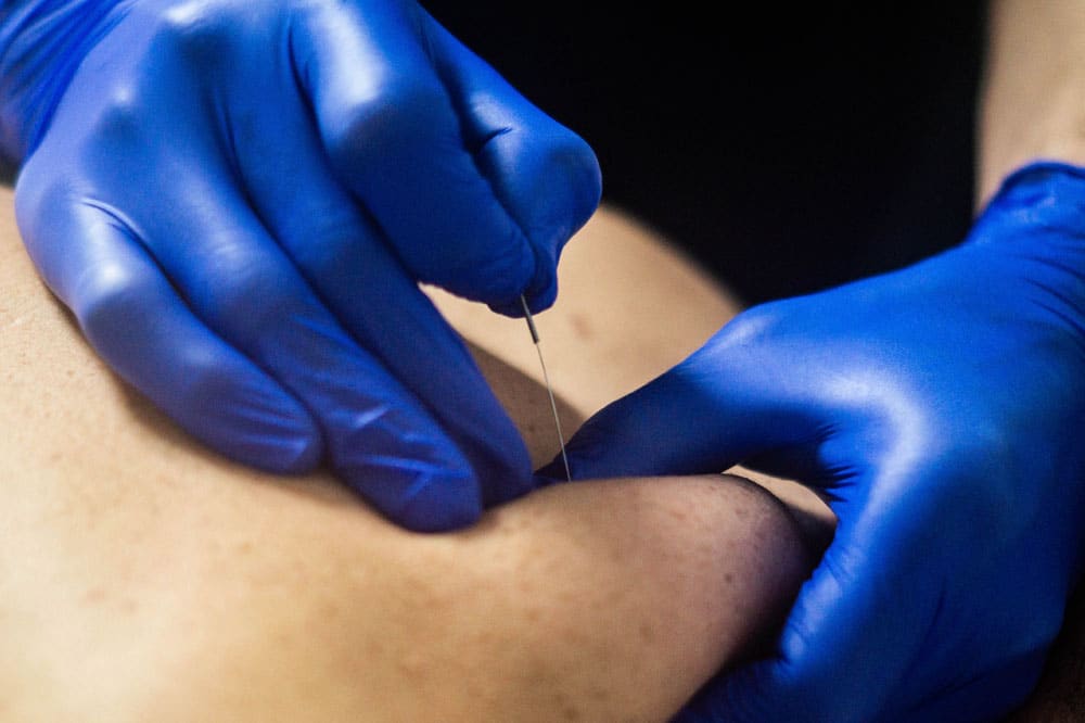 clinica de fisioterapia con puncion seca en vigo